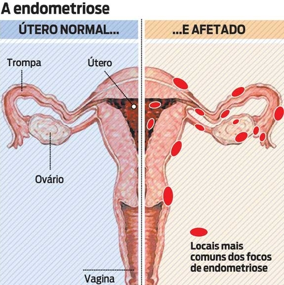 Resultado de imagem para endometriose