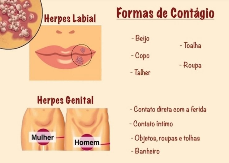 herpes labial genital formas de contágio