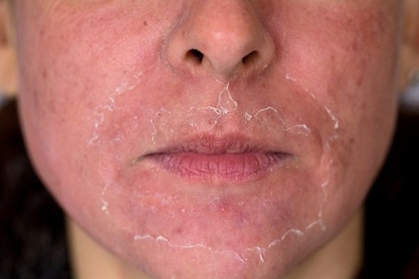 Mary Kay acne superficial profundo benefícios